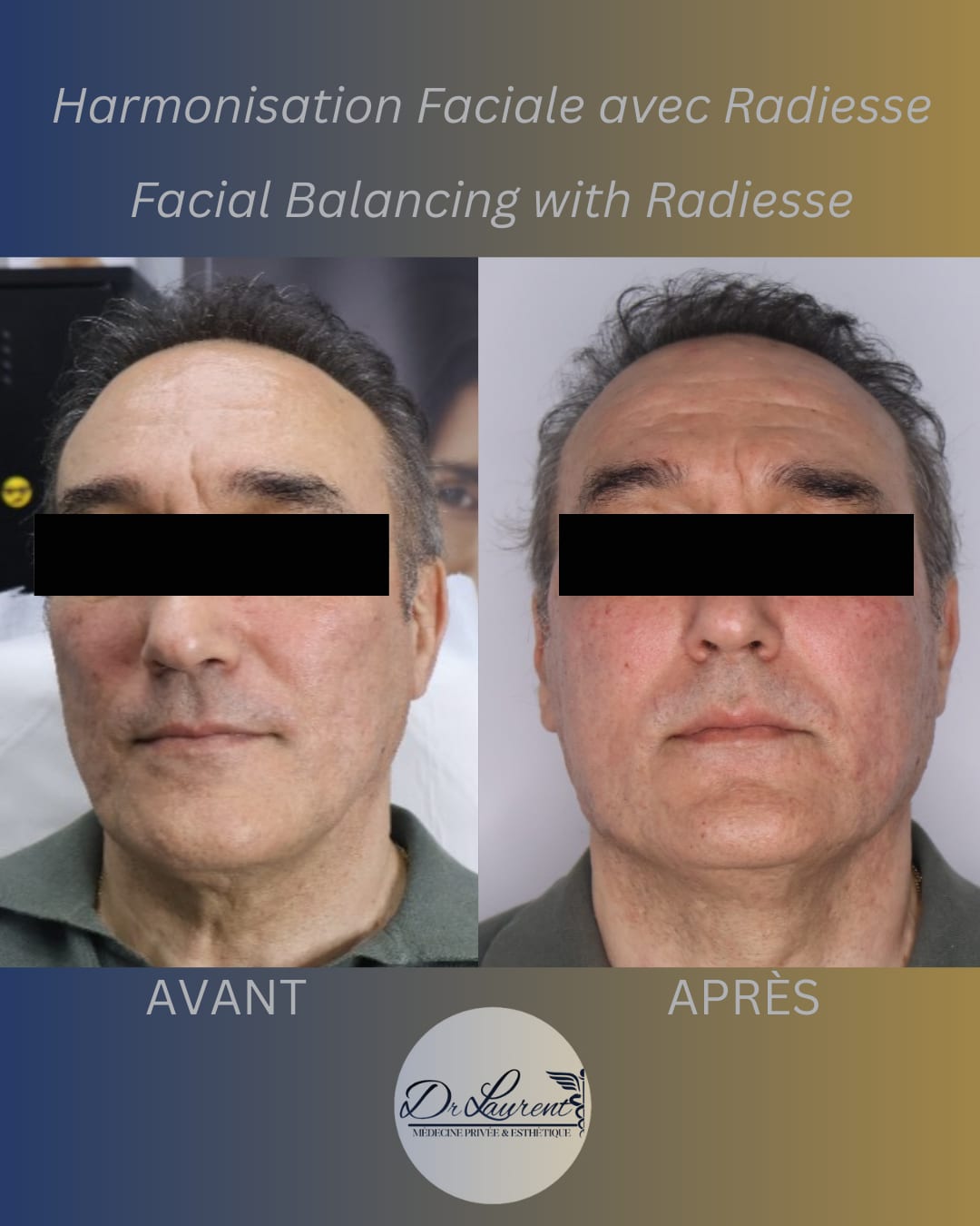Bio-stimulants (Radiesse) — 2