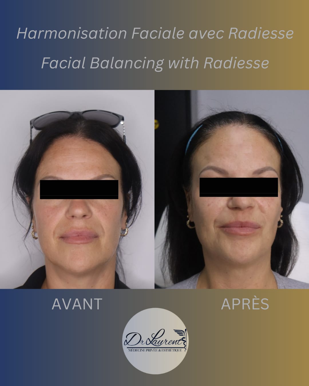 Bio-stimulants (Radiesse) — 3