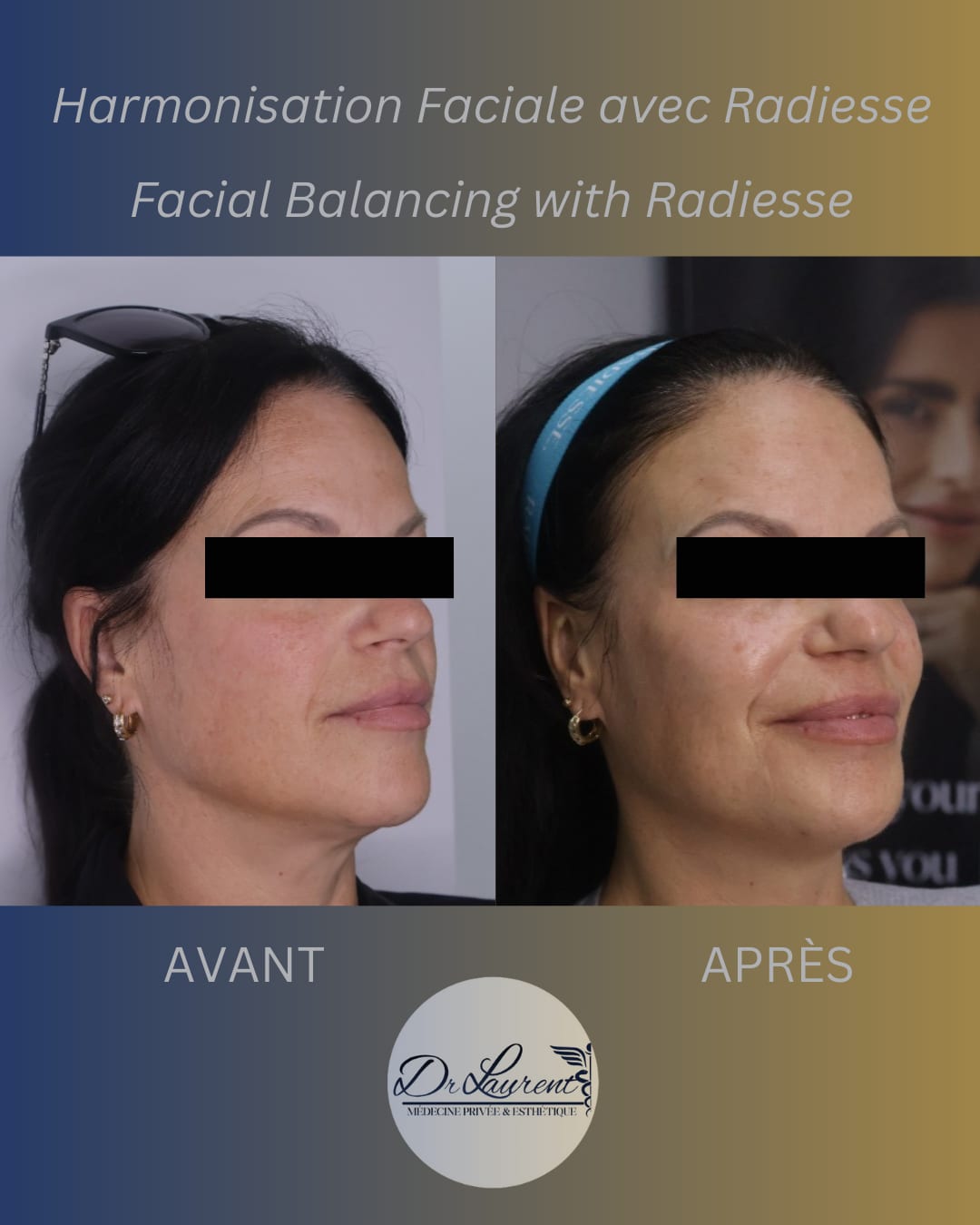 Bio-stimulants (Radiesse) — 4