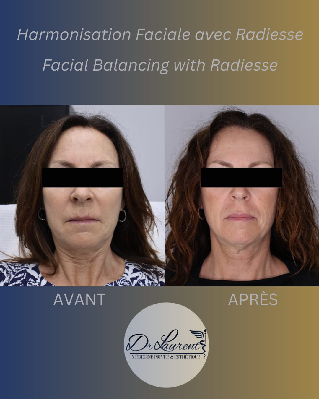 Bio-stimulants (Radiesse) — 5