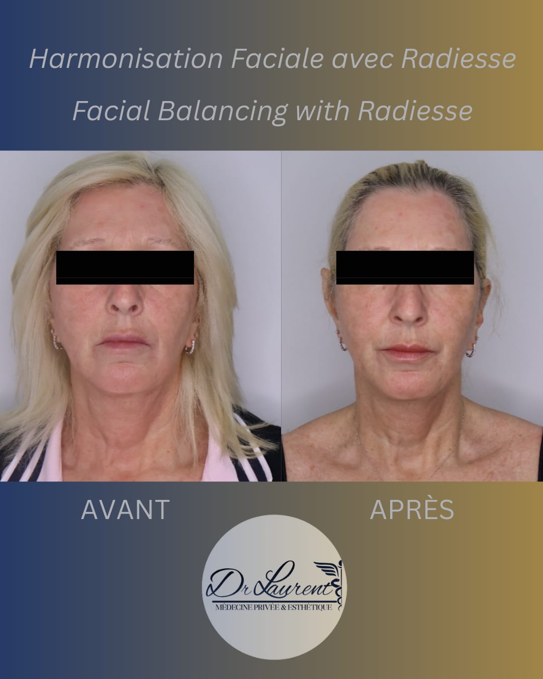 Bio-stimulants (Radiesse) — 6