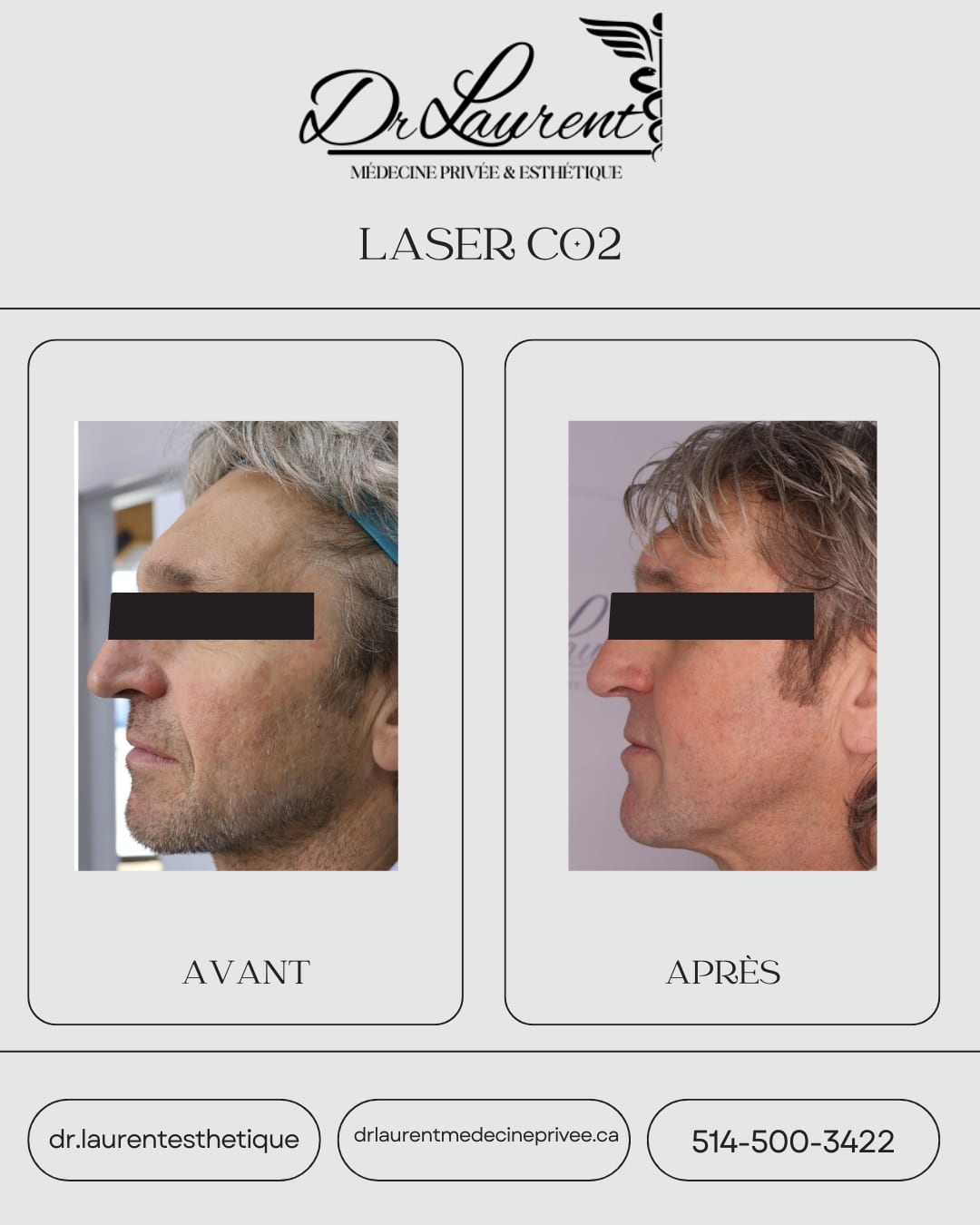 Laser CO2 fractionné — 10
