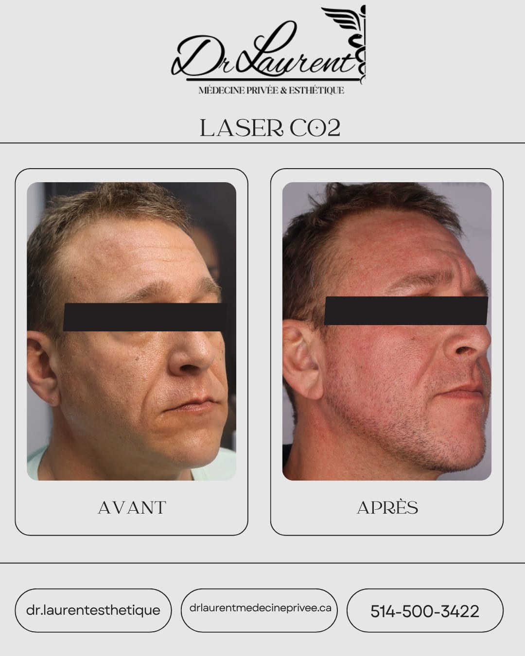 Laser CO2 fractionné — 12