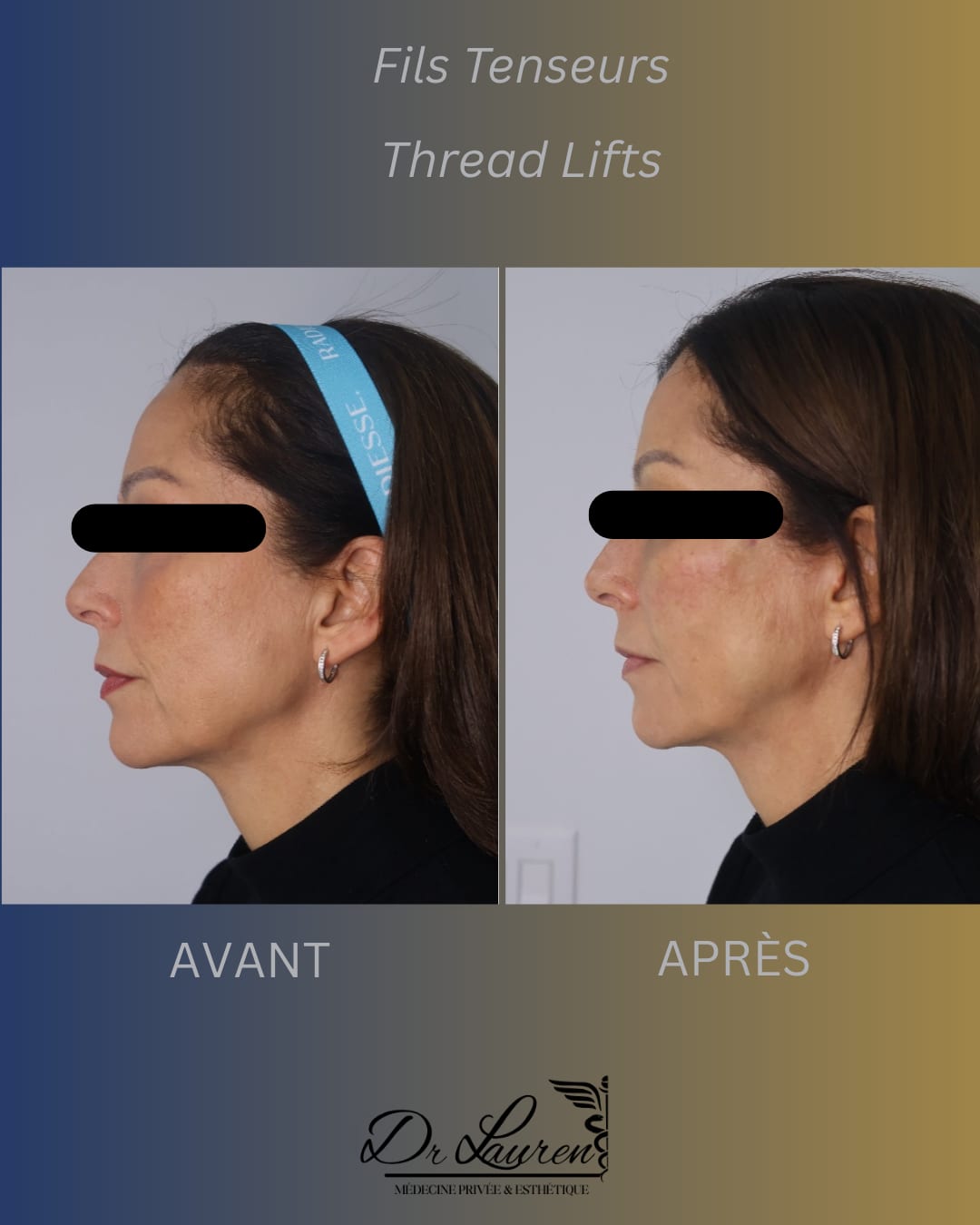 Fils tenseurs APTOS — 2