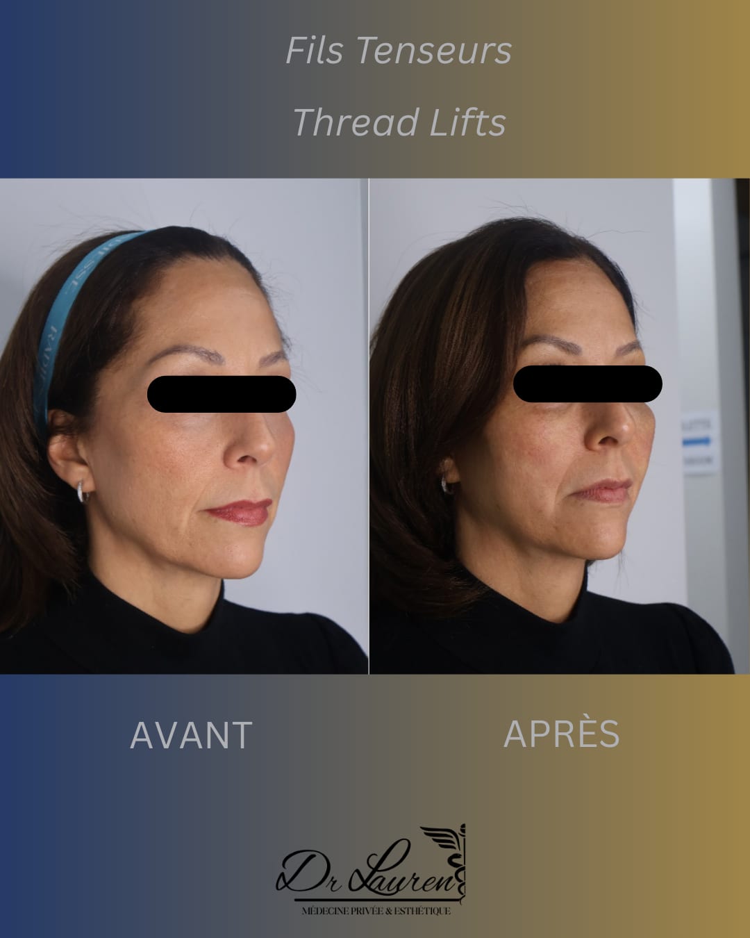 Fils tenseurs APTOS — 3