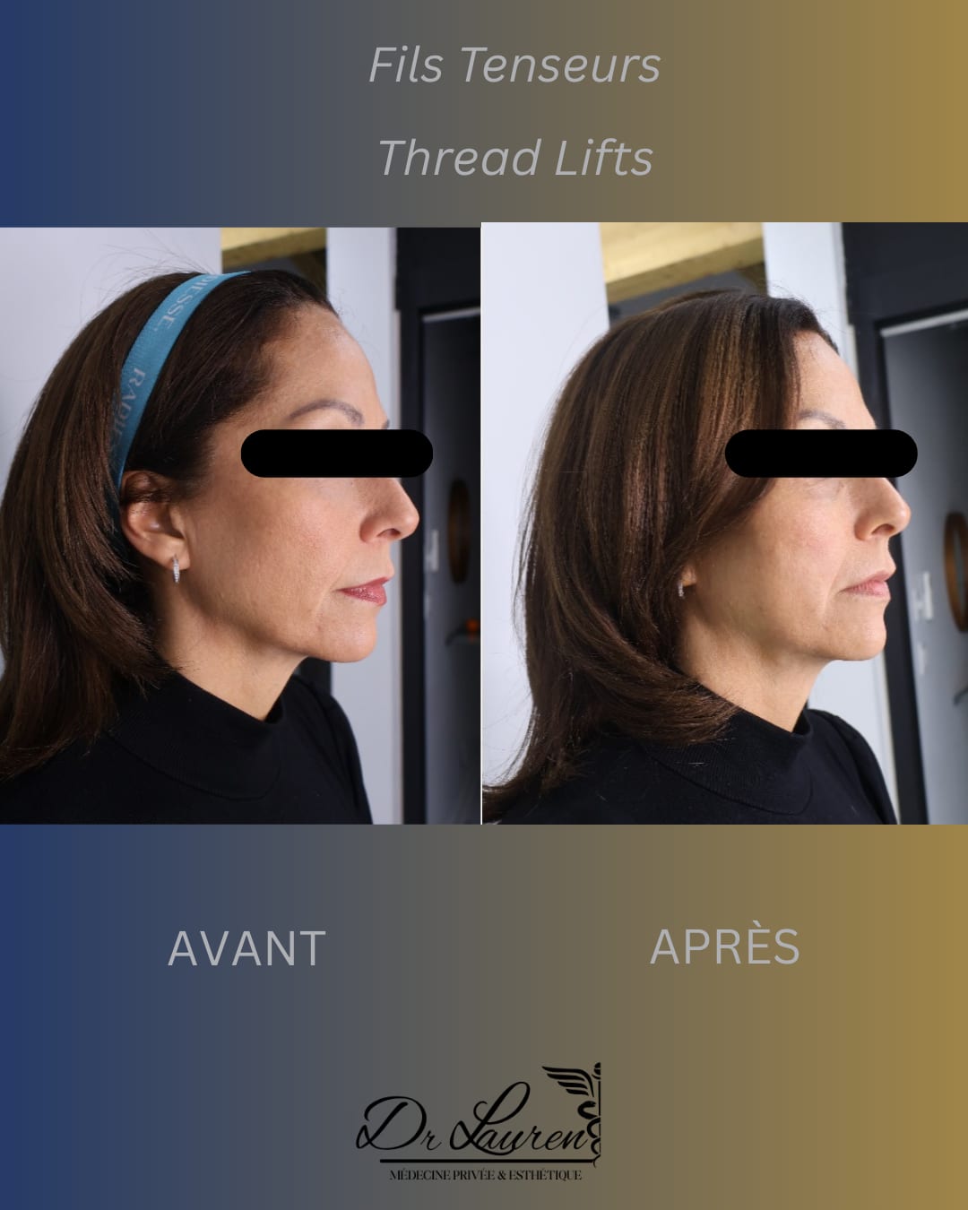 Fils tenseurs APTOS — 4