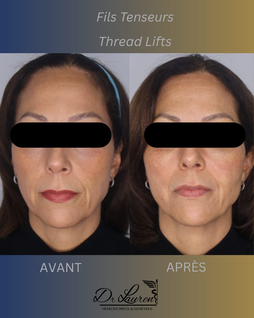 Fils tenseurs APTOS — 5