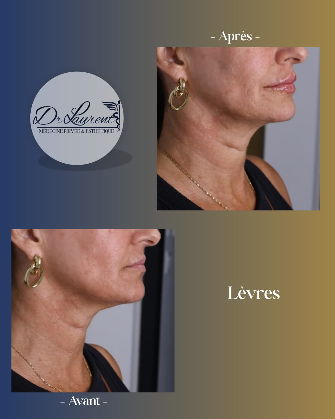 Lèvres — 2