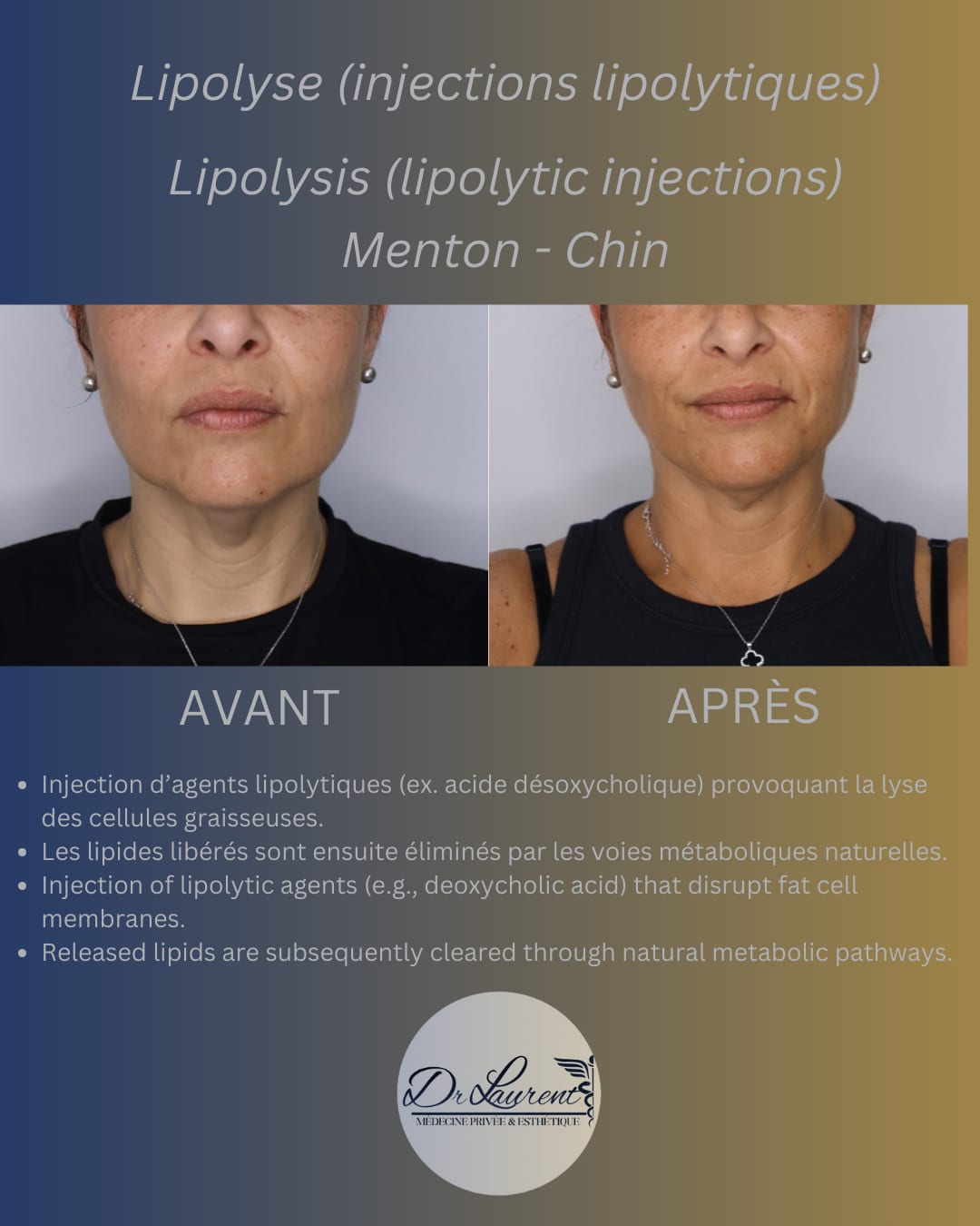 Lipolyse — 2