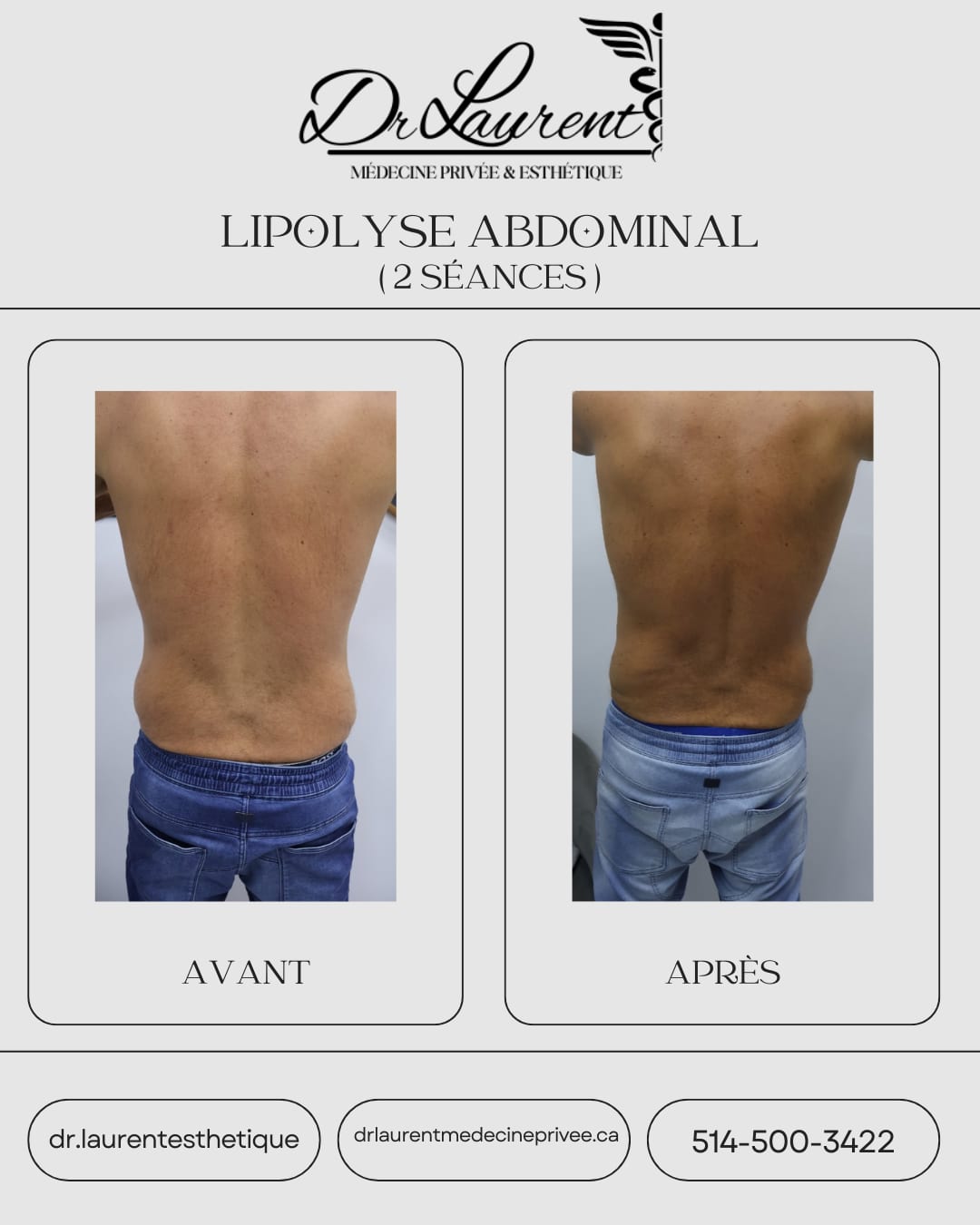 Lipolyse — 3