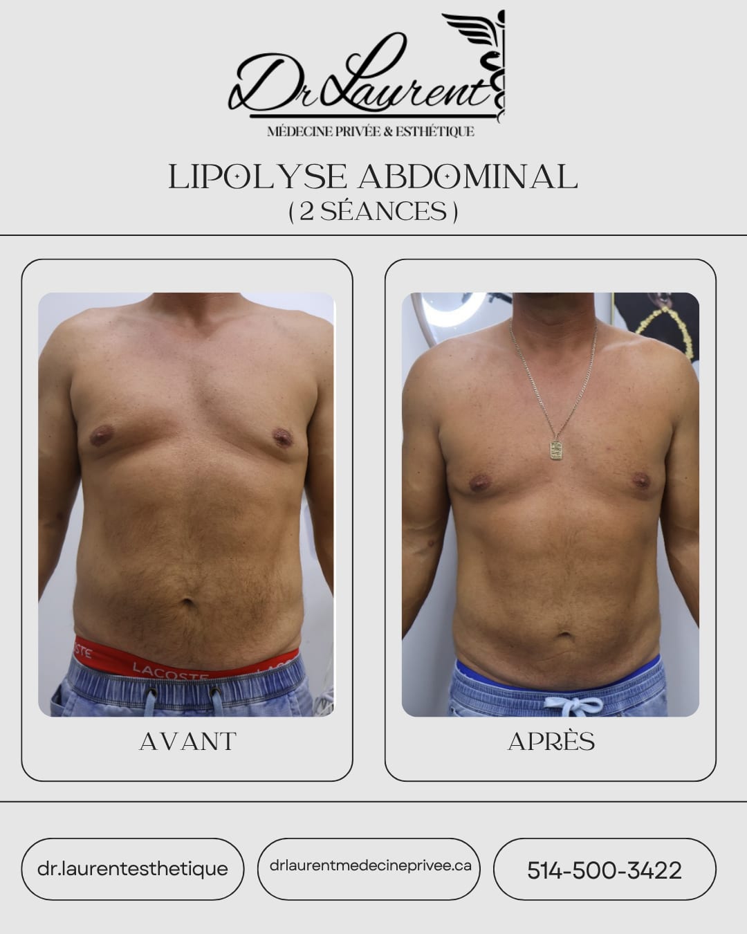 Lipolyse — 4