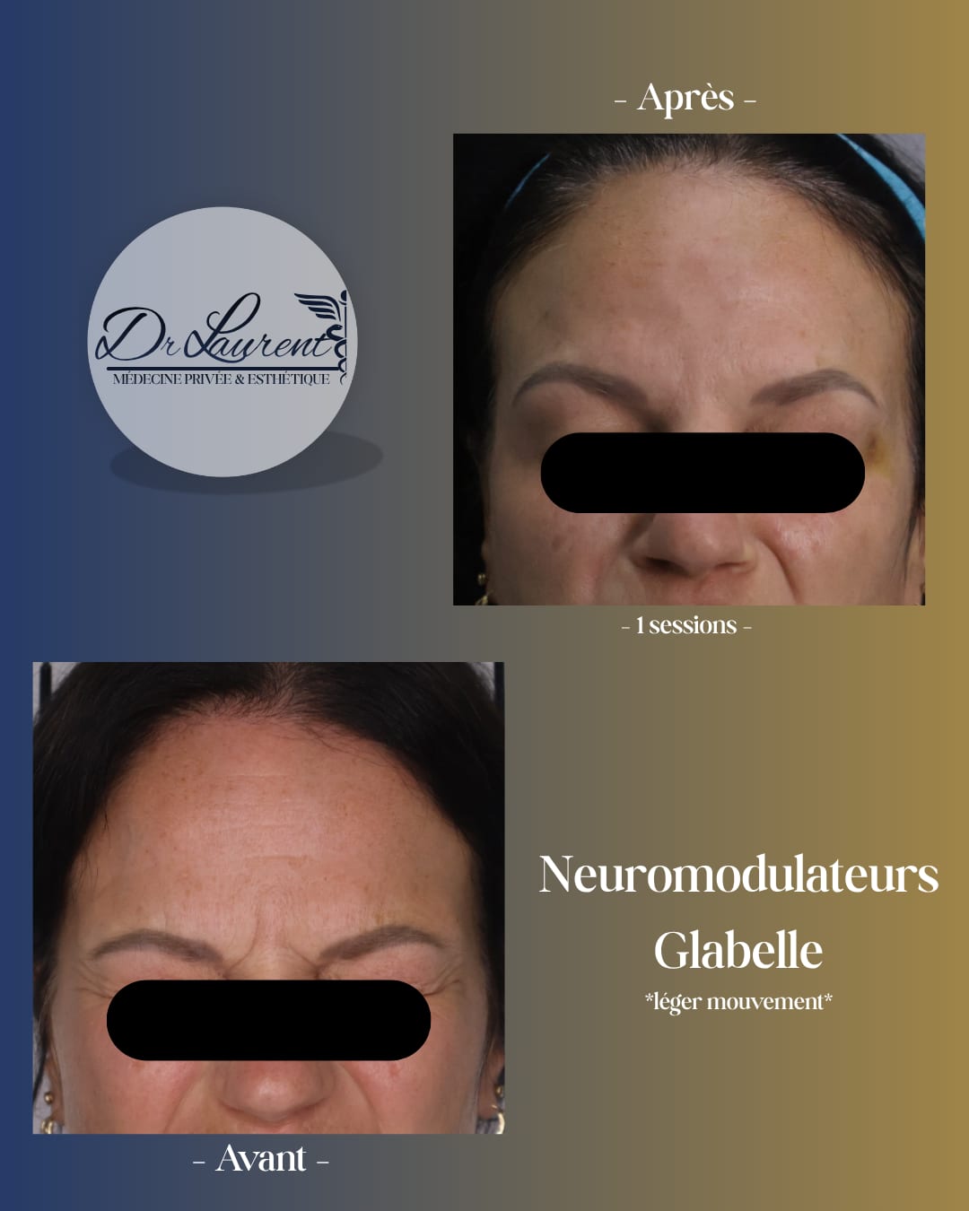 Neuromodulateurs (Botox) — 2