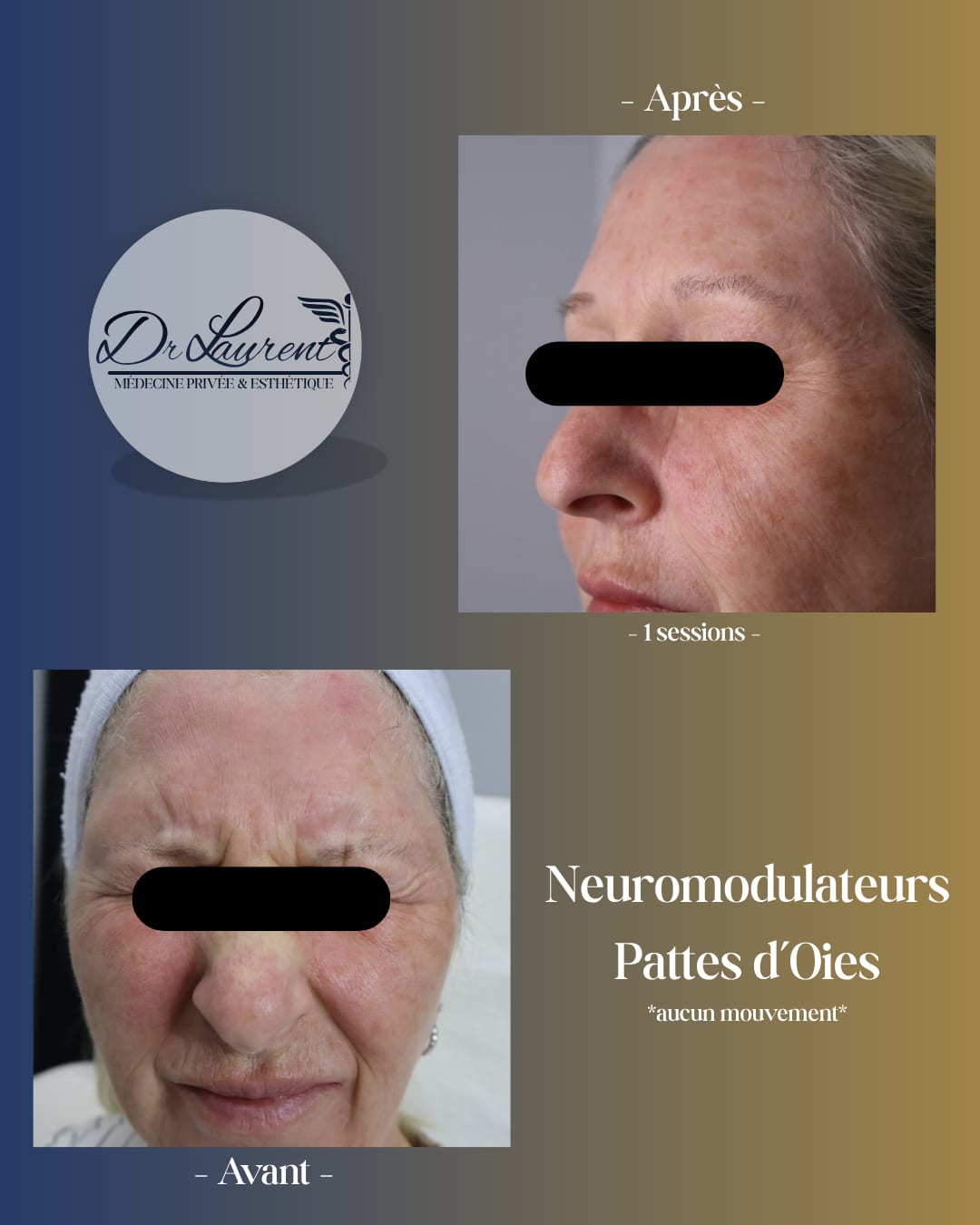 Neuromodulateurs (Botox) — 3