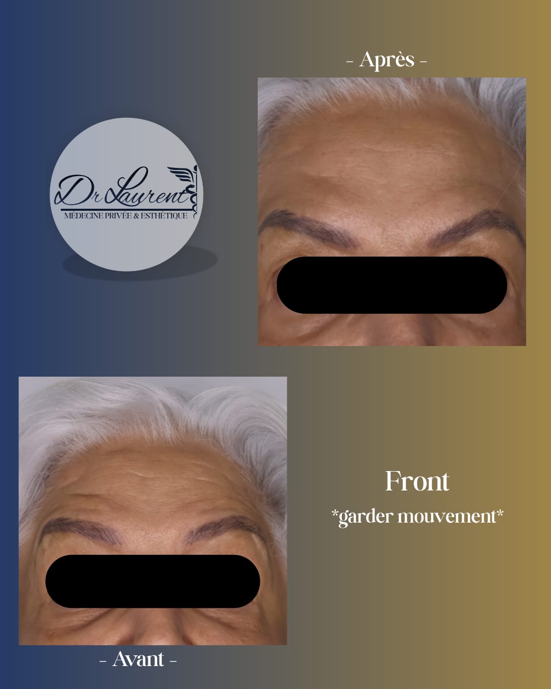 Neuromodulateurs (Botox) — 4