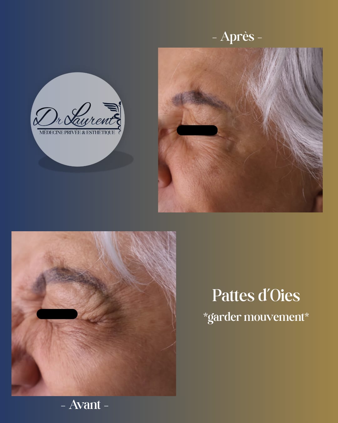 Neuromodulateurs (Botox) — 5
