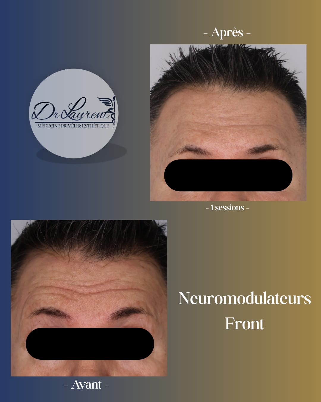 Neuromodulateurs (Botox) — 6