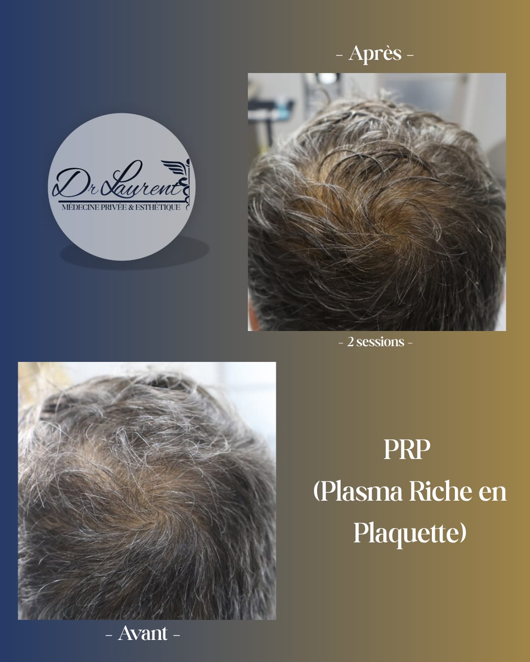 PRP — Plasma riche en plaquettes — 2