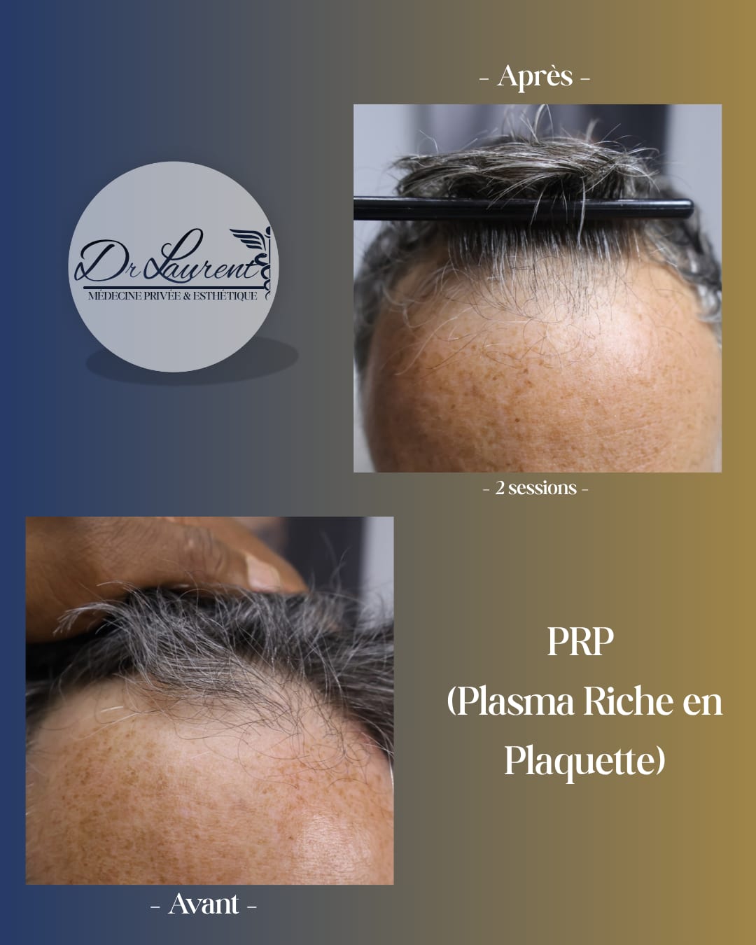 PRP — Plasma riche en plaquettes — 3