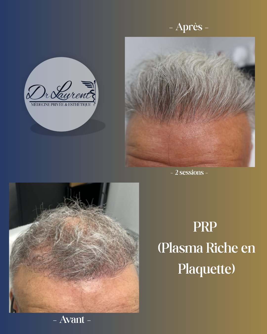 PRP — Plasma riche en plaquettes — 4
