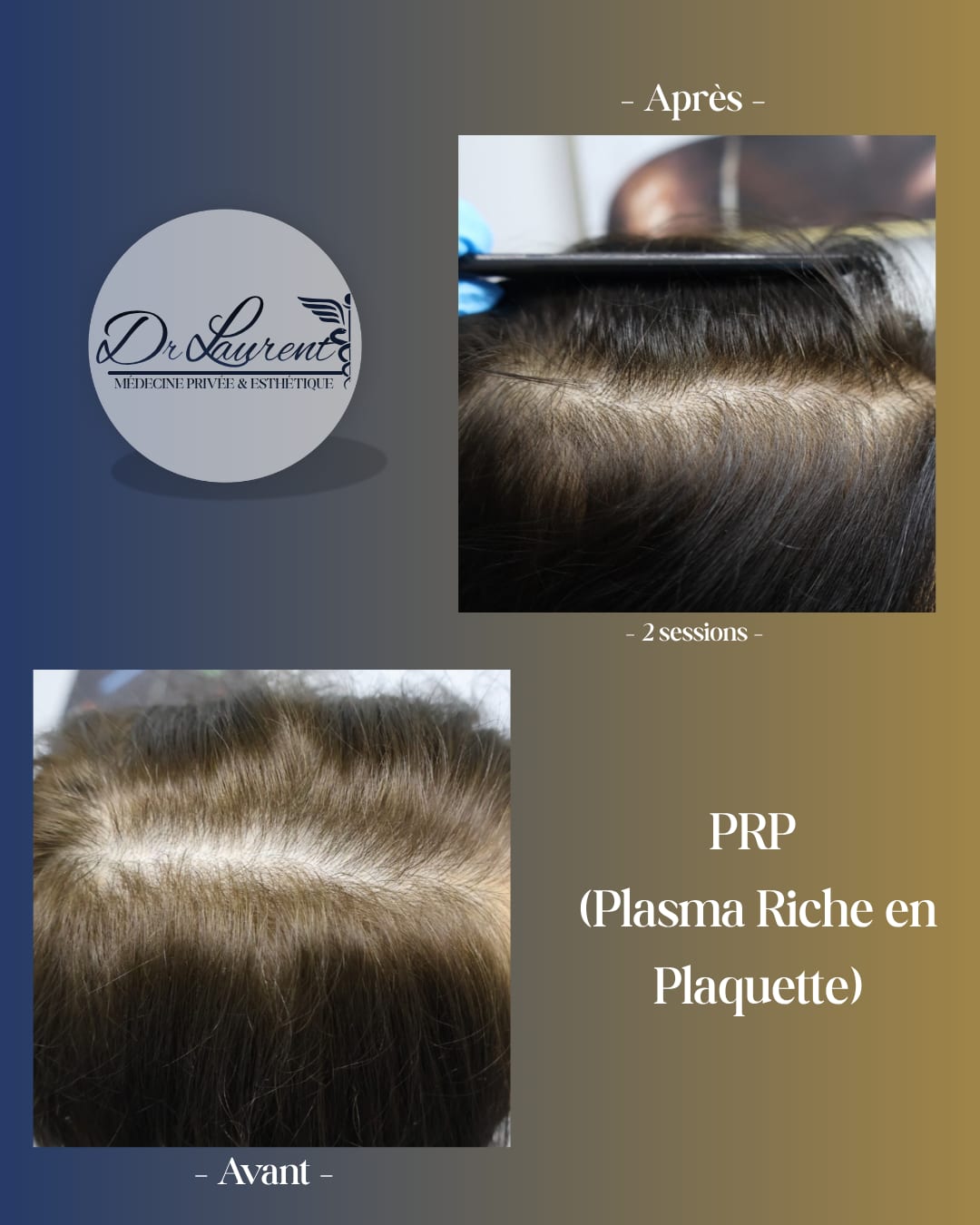 PRP — Plasma riche en plaquettes — 5